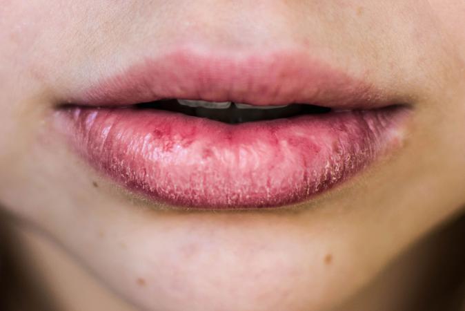 225768-674x450-dry-chapped-lips